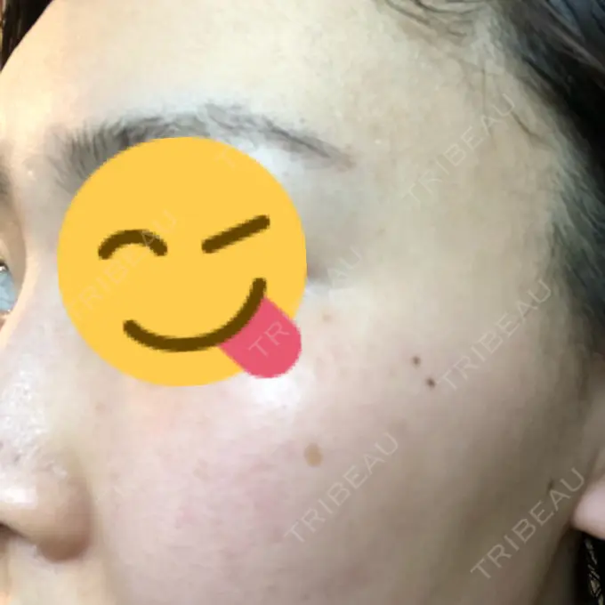 ピコレーザートーニング（美白・肝斑） B-LINE CLINIC 池袋院 AFTER メイン用