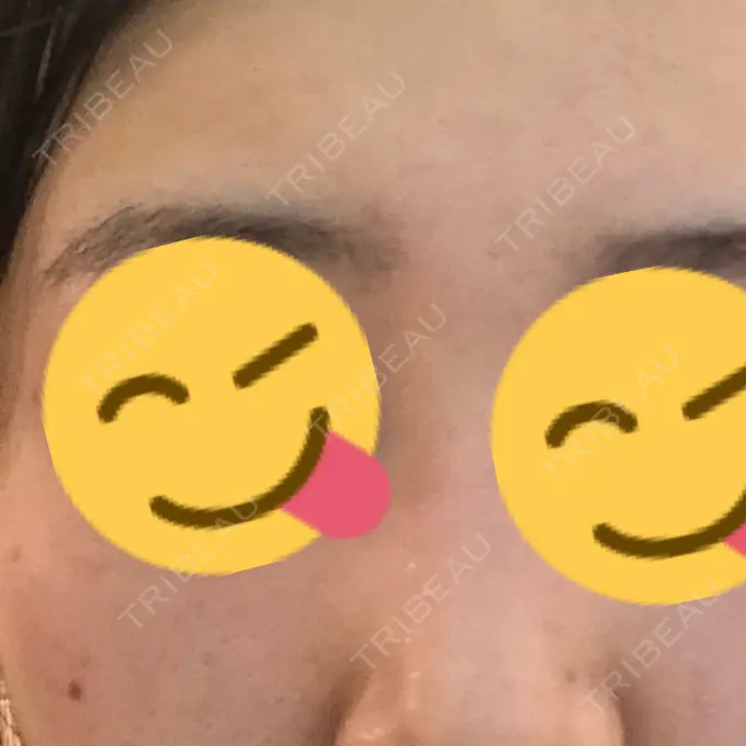 ピコレーザートーニング（美白・肝斑） B-LINE CLINIC 池袋院 DAY 3 メイン用