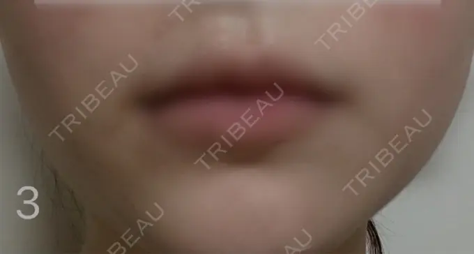 ボトックス（エラ・小顔） TCB東京中央美容外科 札幌駅前院 DAY 3 メイン用