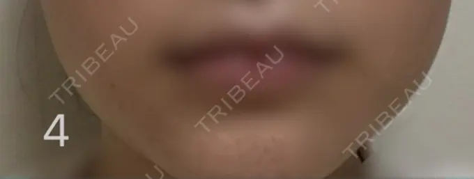 ボトックス（エラ・小顔） TCB東京中央美容外科 札幌駅前院 DAY 4 メイン用