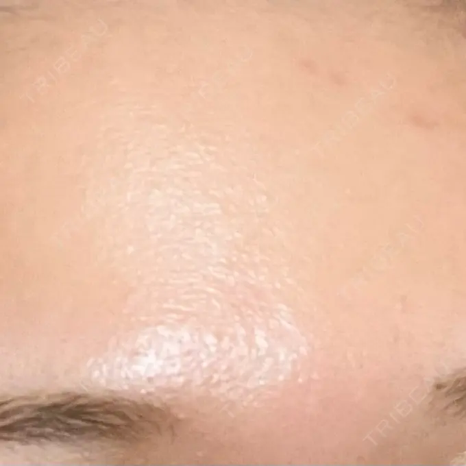 光治療（フォトフェイシャルなど） 渋谷美容外科クリニック 新橋院 AFTER メイン用