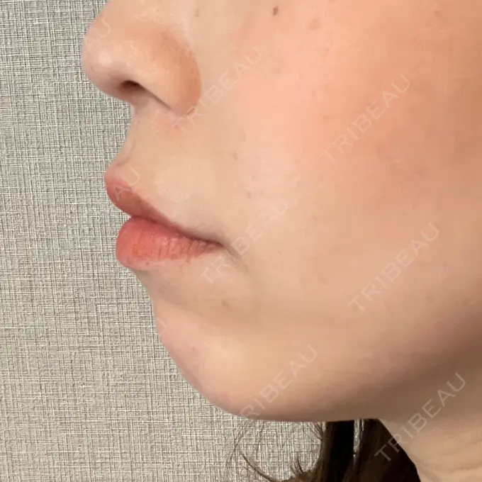 ヒアルロン酸注入（あご） / ボトックス（エラ・小顔） ルラ美容クリニック 池袋院 DAY 0 メイン用