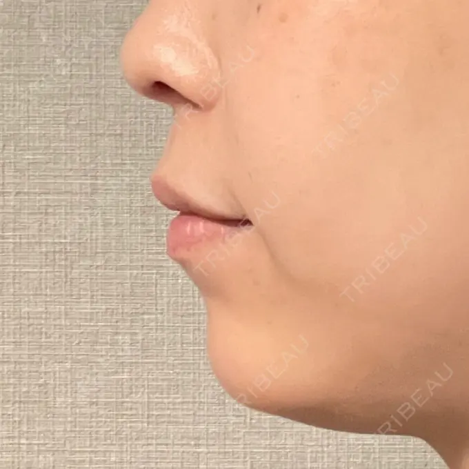 ヒアルロン酸注入（あご） / ボトックス（エラ・小顔） ルラ美容クリニック 池袋院 DAY 8 メイン用