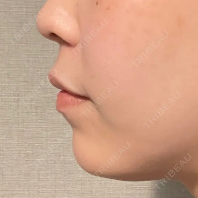 ヒアルロン酸注入（あご） / ボトックス（エラ・小顔） ルラ美容クリニック 池袋院 DAY 9 メイン用