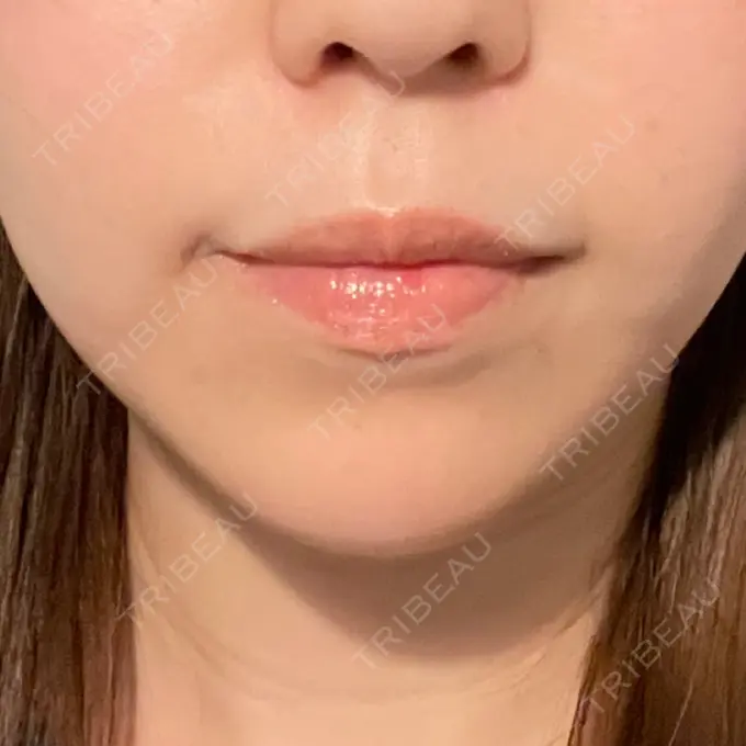 ヒアルロン酸注入（あご） / ボトックス（エラ・小顔） ルラ美容クリニック 池袋院 DAY 9 メイン用