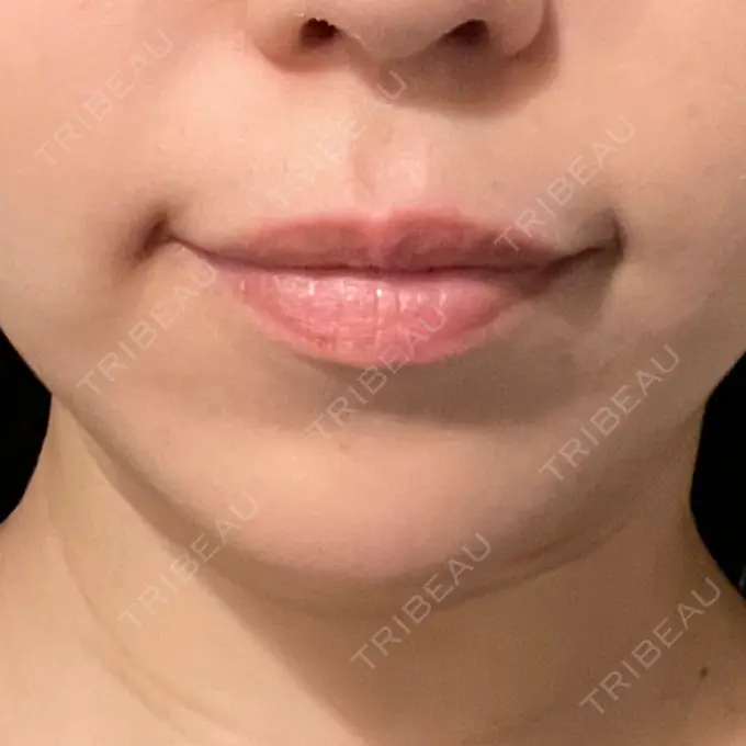 ヒアルロン酸注入（あご） / ボトックス（エラ・小顔） ルラ美容クリニック 池袋院 DAY 15 メイン用