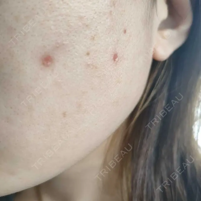 シミ取りレーザー 小田原マタニティクリニック DAY 15 メイン用