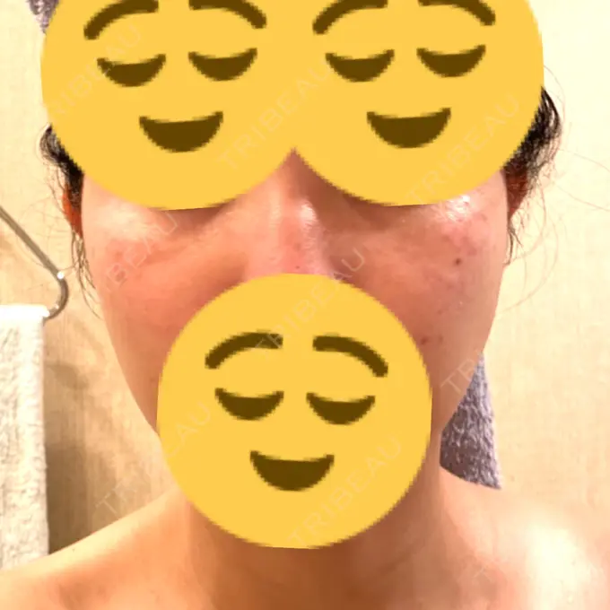 ルビーレーザー みずほクリニック DAY 18 メイン用