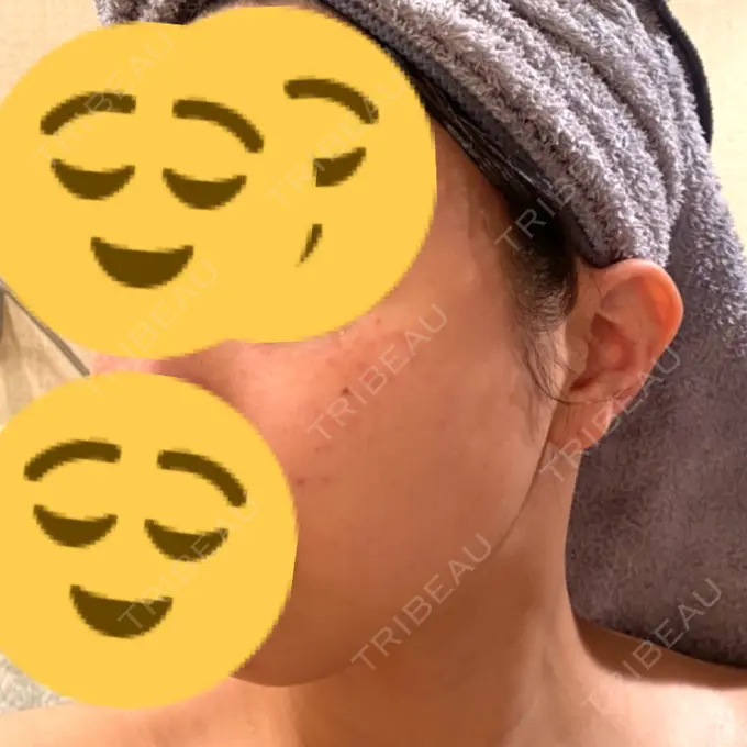 ルビーレーザー みずほクリニック DAY 18 メイン用