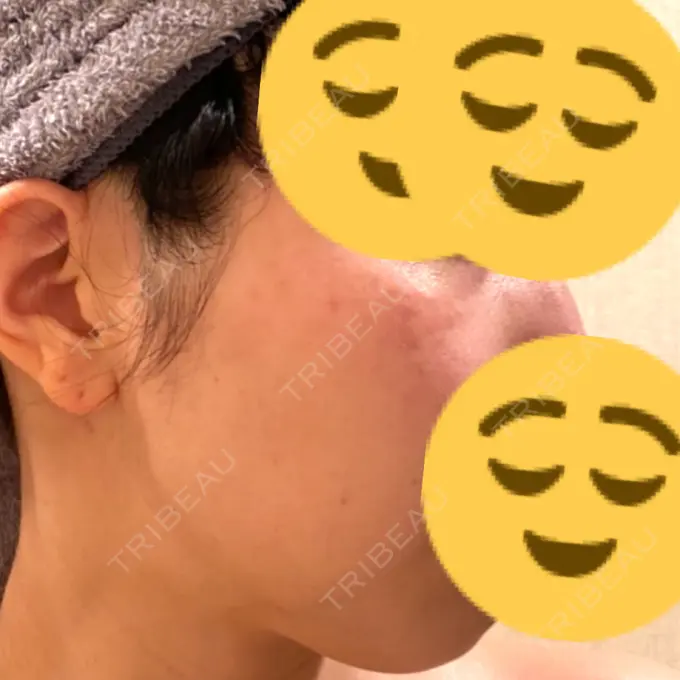 ルビーレーザー みずほクリニック DAY 18 メイン用