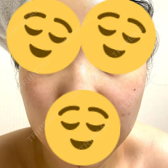 ルビーレーザー みずほクリニック AFTER メイン用