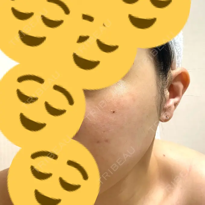 ルビーレーザー みずほクリニック DAY 111 メイン用