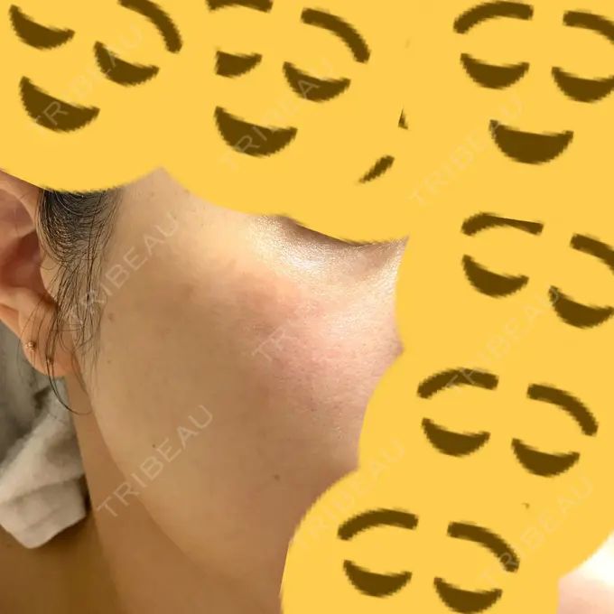 ルビーレーザー みずほクリニック DAY 111 メイン用