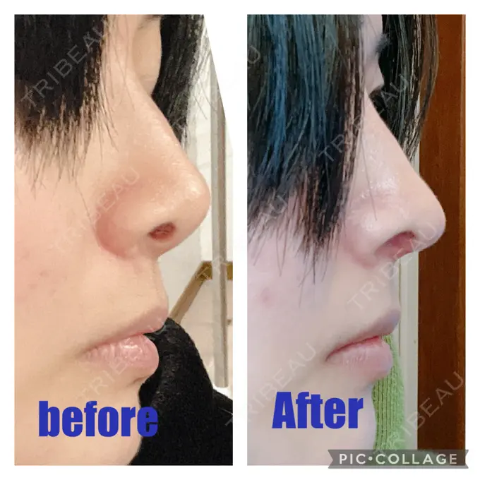 鼻中隔延長（切開） みずほクリニック DAY 40 メイン用