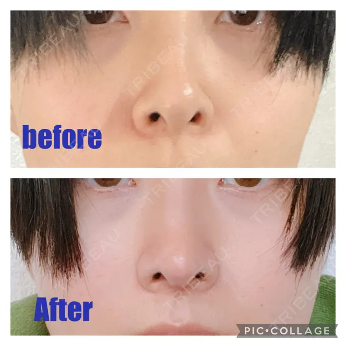 鼻中隔延長（切開） みずほクリニック DAY 40 メイン用