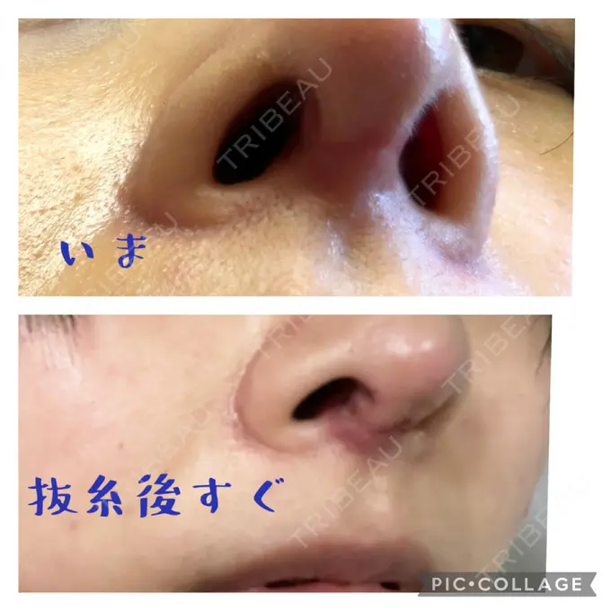 鼻中隔延長（切開） みずほクリニック DAY 40 メイン用