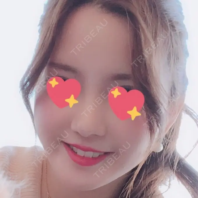 隆鼻術 / 鼻尖形成（切開） / 鼻中隔延長（切開） / 小鼻縮小（切開） / 軟骨移植 / 骨切幅寄せ id（アイディ）美容外科 DAY 55 メイン用