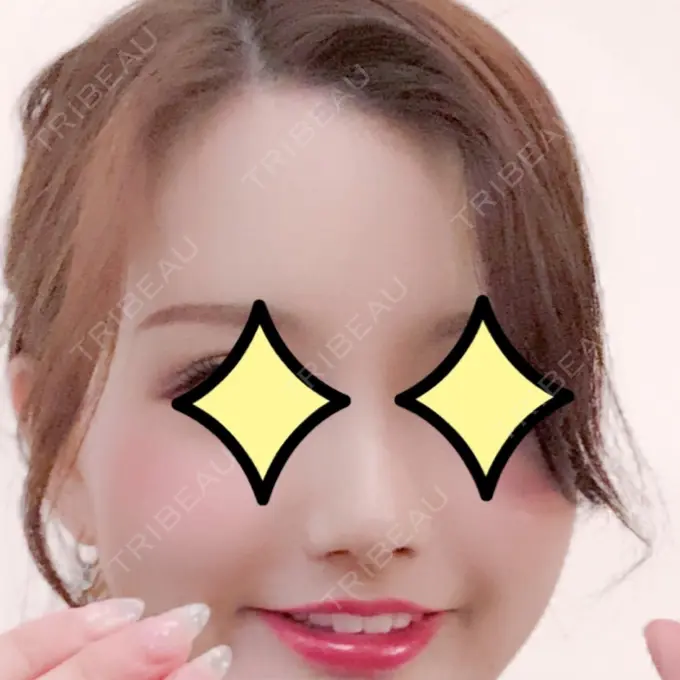 隆鼻術 / 鼻尖形成（切開） / 鼻中隔延長（切開） / 小鼻縮小（切開） / 軟骨移植 / 骨切幅寄せ id（アイディ）美容外科 DAY 55 メイン用