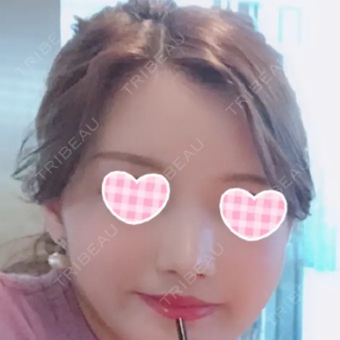 隆鼻術 / 鼻尖形成（切開） / 鼻中隔延長（切開） / 小鼻縮小（切開） / 軟骨移植 / 骨切幅寄せ id（アイディ）美容外科 DAY 55 メイン用