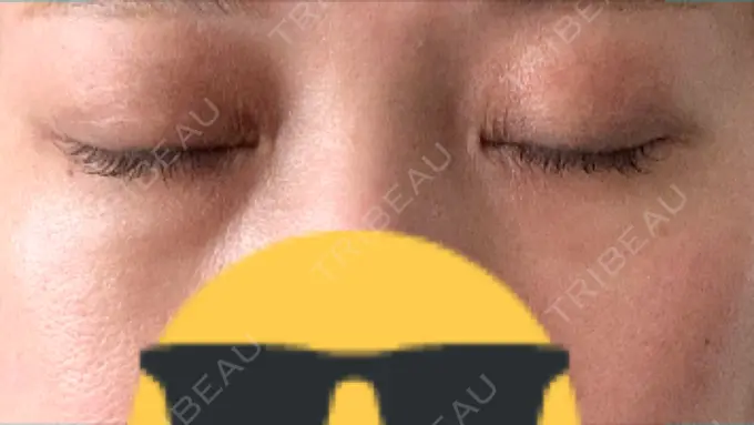 ヒアルロン酸注入（目の下） 渋谷美容外科クリニック 渋谷院 DAY 7 メイン用