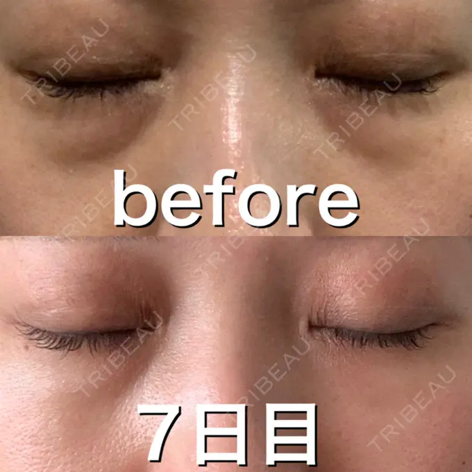 ヒアルロン酸注入（目の下） 渋谷美容外科クリニック 渋谷院 DAY 7 メイン用