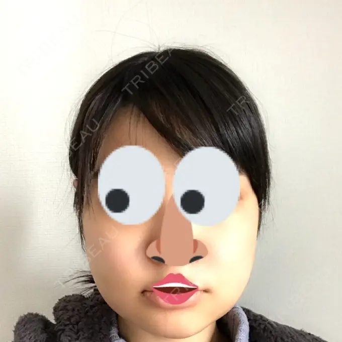 骨切り（あご） / 骨削り（エラ） / 骨削り（頬） よこはまエーブクリニック DAY 9 メイン用