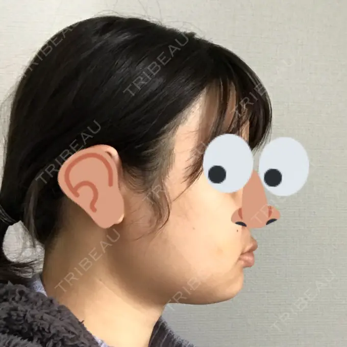 骨切り（あご） / 骨削り（エラ） / 骨削り（頬） よこはまエーブクリニック DAY 9 メイン用