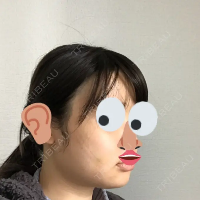 骨切り（あご） / 骨削り（エラ） / 骨削り（頬） よこはまエーブクリニック DAY 9 メイン用