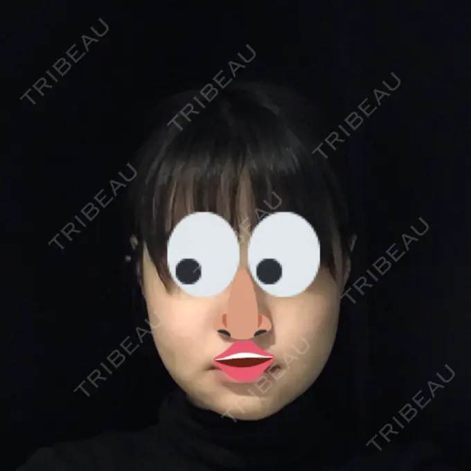 骨切り（あご） / 骨削り（エラ） / 骨削り（頬） よこはまエーブクリニック DAY 10 メイン用