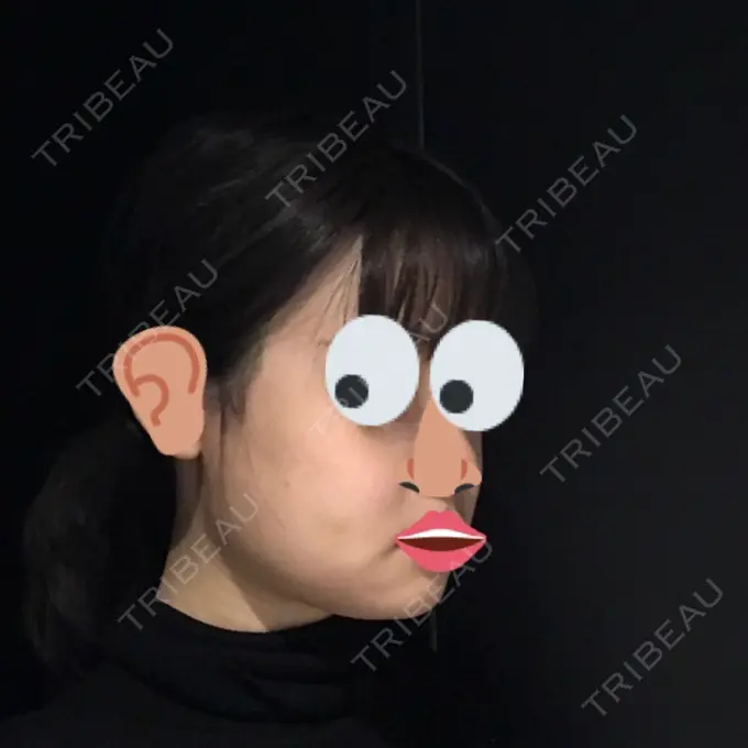 骨切り（あご） / 骨削り（エラ） / 骨削り（頬） よこはまエーブクリニック DAY 10 メイン用