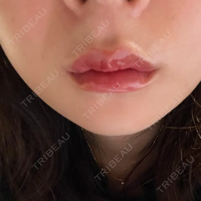 ヒアルロン酸注入（唇） フィラークリニック 名古屋栄院 AFTER メイン用