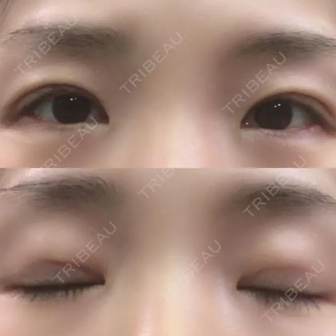 二重埋没 湘南美容クリニック 長野院 AFTER メイン用