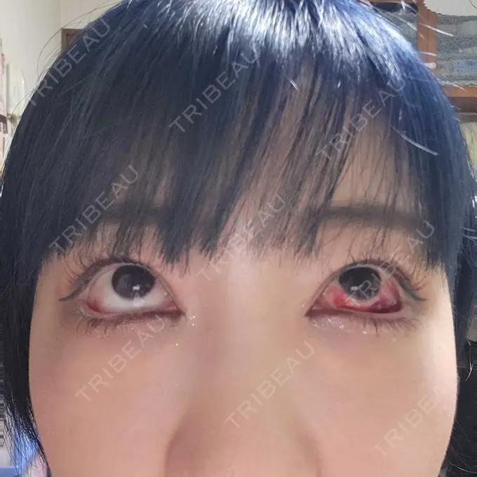 下まぶたたるみ取り / 下まぶたの脂肪取り 湘南美容クリニック 藤沢院 DAY 3 メイン用