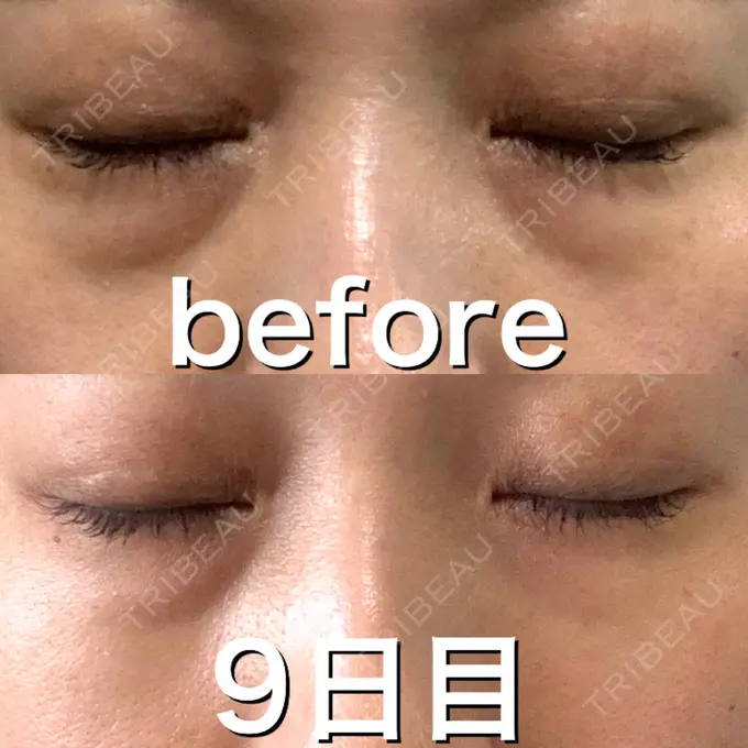 ヒアルロン酸注入（目の下） 渋谷美容外科クリニック 渋谷院 DAY 9 メイン用