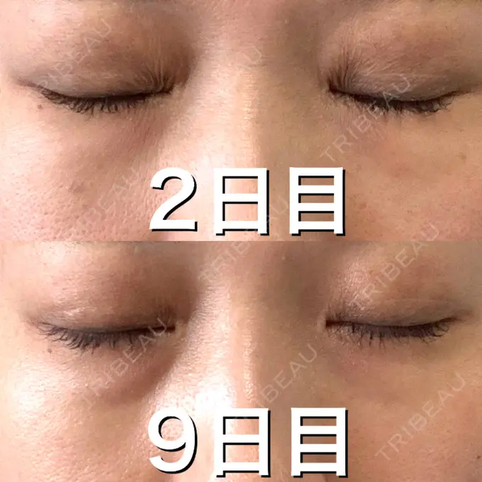 ヒアルロン酸注入（目の下） 渋谷美容外科クリニック 渋谷院 DAY 9 メイン用