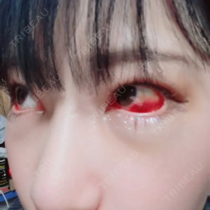 下まぶたたるみ取り / 下まぶたの脂肪取り 湘南美容クリニック 藤沢院 DAY 4 メイン用