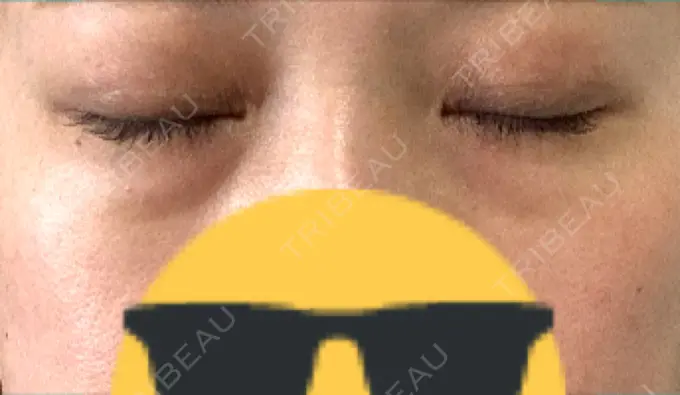 ヒアルロン酸注入（目の下） 渋谷美容外科クリニック 渋谷院 AFTER メイン用