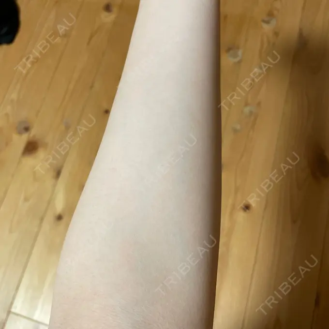 医療脱毛（全身） STARS CLINIC DAY 8 メイン用