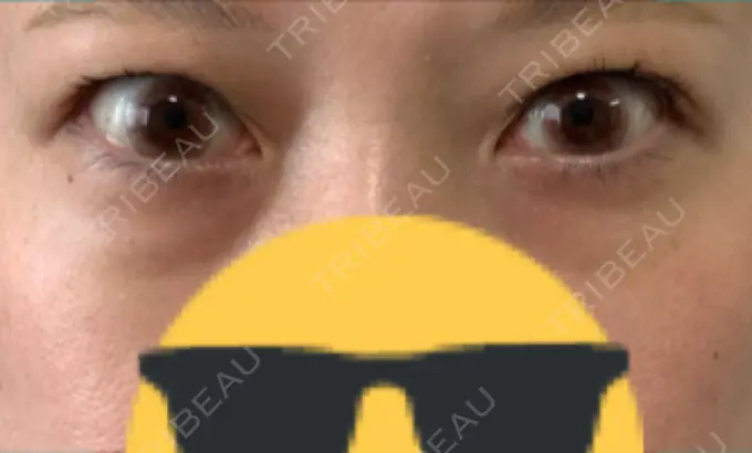 ヒアルロン酸注入（目の下） 渋谷美容外科クリニック 渋谷院 DAY 10 メイン用