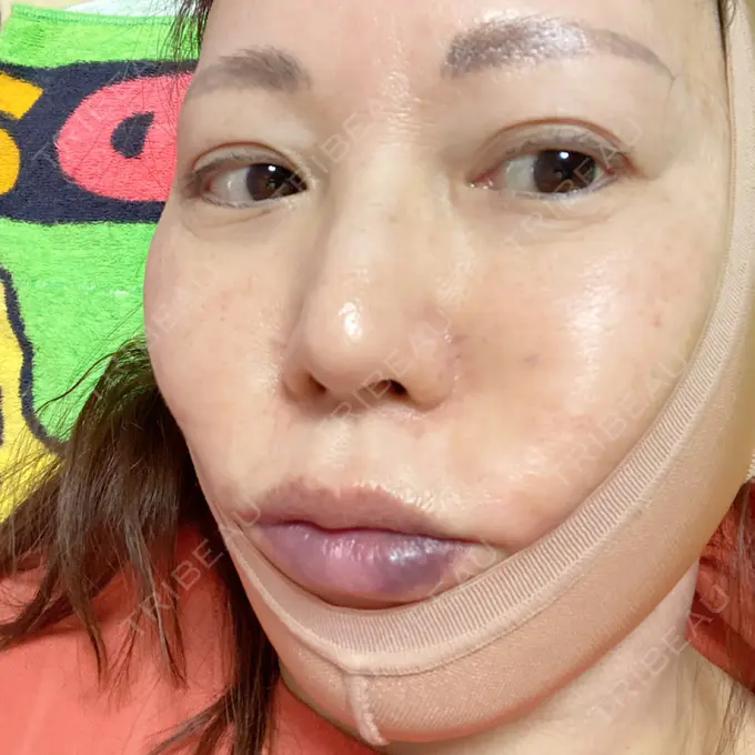 糸リフト / 脂肪吸引（顔） / ジョールファット除去 / その他（輪郭） 湘南美容クリニック 秋葉原院 DAY 2 メイン用