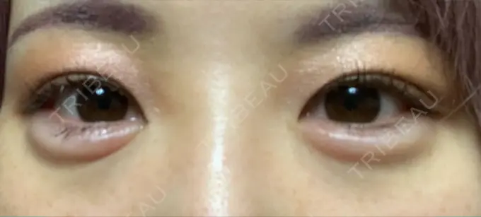 ヒアルロン酸注入（涙袋） 渋谷美容外科クリニック 渋谷院 DAY 1 メイン用