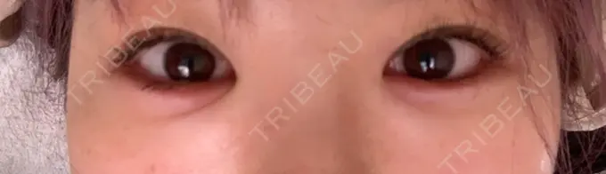 ヒアルロン酸注入（涙袋） 渋谷美容外科クリニック 渋谷院 DAY 1 メイン用