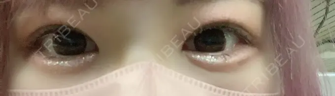 ヒアルロン酸注入（涙袋） 渋谷美容外科クリニック 渋谷院 DAY 1 メイン用