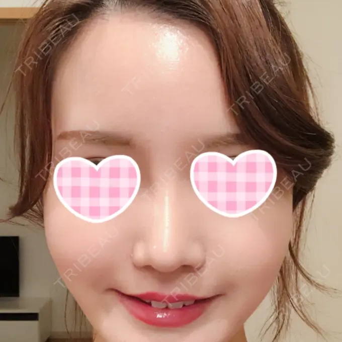 隆鼻術 / 鼻尖形成（切開） / 鼻中隔延長（切開） / 小鼻縮小（切開） / 軟骨移植 / 骨切幅寄せ id（アイディ）美容外科 AFTER メイン用