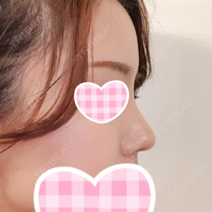 隆鼻術 / 鼻尖形成（切開） / 鼻中隔延長（切開） / 小鼻縮小（切開） / 軟骨移植 / 骨切幅寄せ id（アイディ）美容外科 DAY 70 メイン用