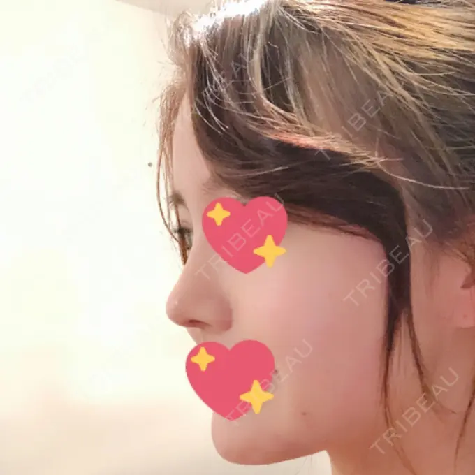 隆鼻術 / 鼻尖形成（切開） / 鼻中隔延長（切開） / 小鼻縮小（切開） / 軟骨移植 / 骨切幅寄せ id（アイディ）美容外科 DAY 70 メイン用