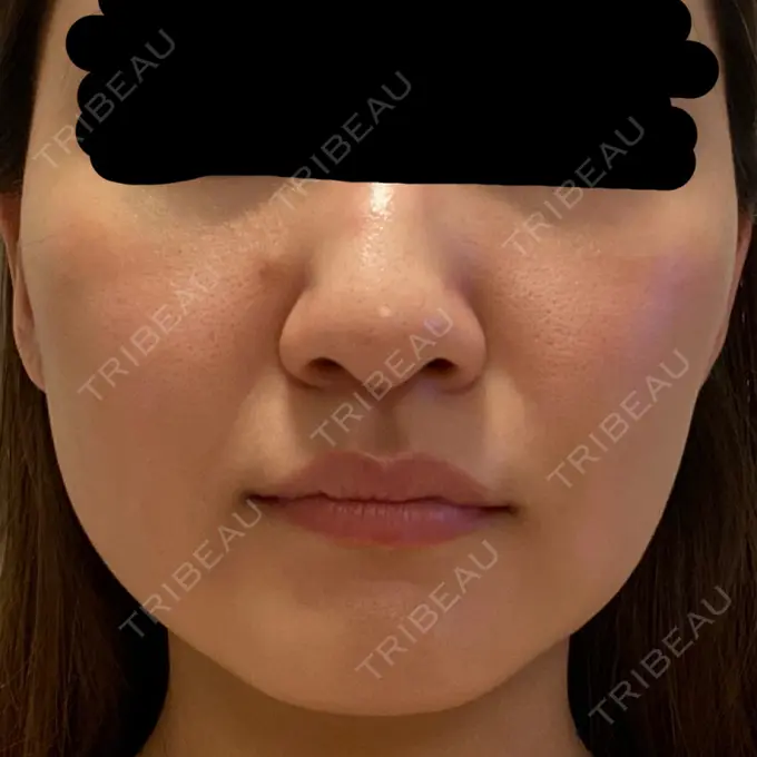 糸リフト / バッカルファット除去 / 脂肪吸引（顔） 東京ミッドクリニック AFTER メイン用