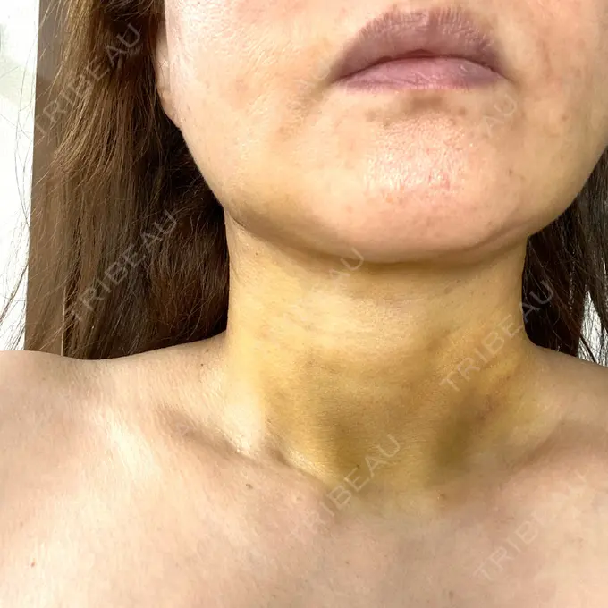 糸リフト / 脂肪吸引（顔） / ジョールファット除去 / その他（輪郭） 湘南美容クリニック 秋葉原院 DAY 3 メイン用