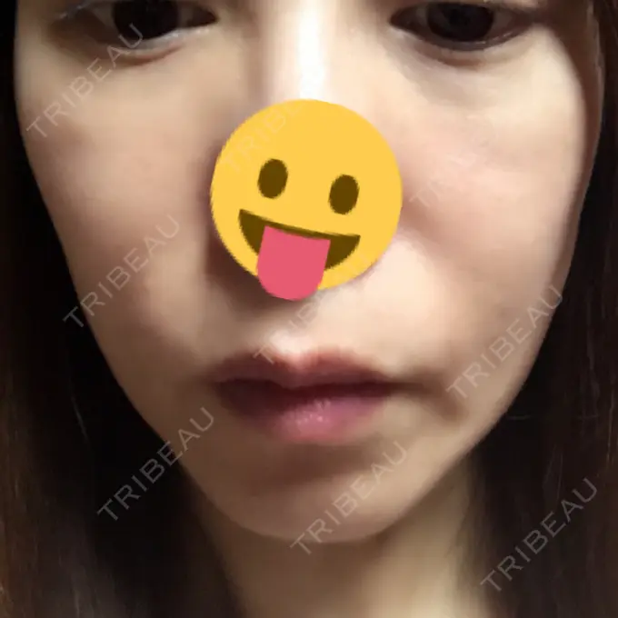 脂肪溶解注射（顔） 湘南美容クリニック 東京蒲田院 DAY 8 メイン用