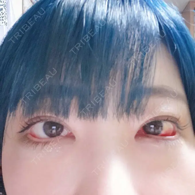 下まぶたたるみ取り / 下まぶたの脂肪取り 湘南美容クリニック 藤沢院 DAY 8 メイン用